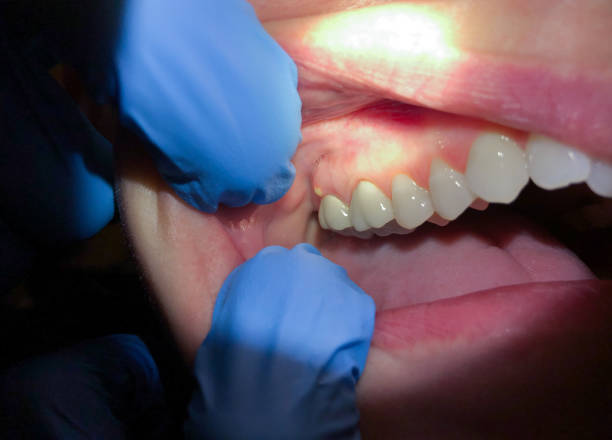 Best Emergency Dentist for Knocked-Out Tooth in Bridgehampton, NY