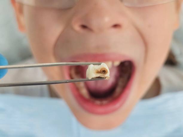 Best Broken or Cracked Tooth Emergency Dentist in Bridgehampton, NY